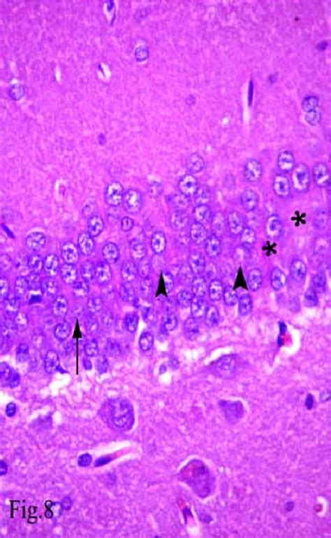 Showing Areas Devoid Of Granule Cells Some Karyolytic And