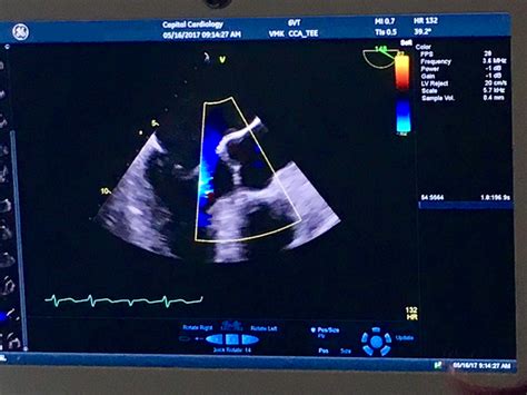 Tee Cardioversion — Capital Cardiology Associates