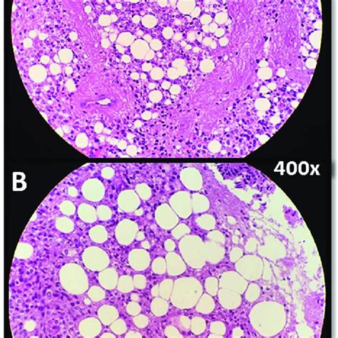 Round Shaped Tumor Cells With Small Monomorphic Nuclei And Clear