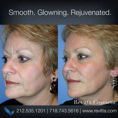 Non Surgical Facial Rejuvenation At Revitta Cosmetic Clinic Manhattan