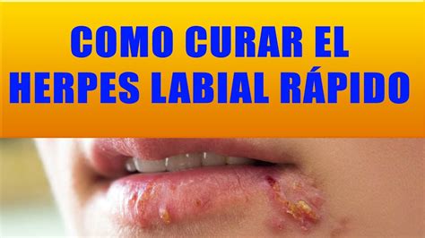 Como Quitar El Herpes Labial Con Simples Remedios Caseros Herpes