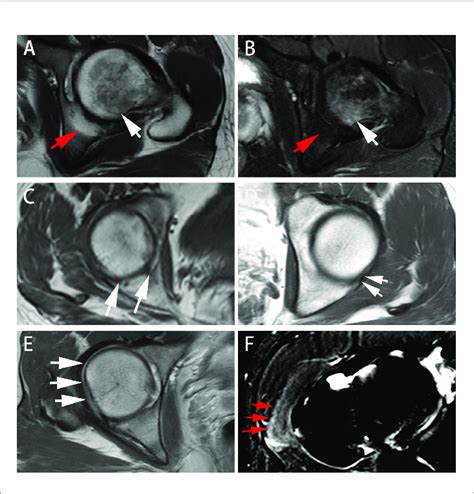 | Different presentations on axial MRI in axSpA patients with hip ...