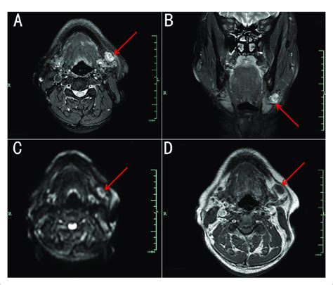 Magnetic Resonance Imaging Mri Of A Lesion Beside The Left