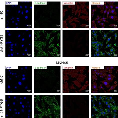 Pygb Knockdown Inhibited Emt In Gastric Cancer Cells A Download