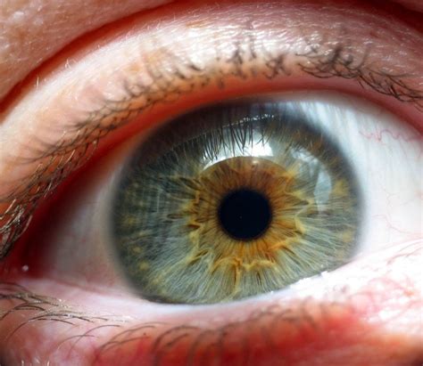 Enfermedades Hereditarias De Retina Qu Es S Ntomas Y Tratamiento