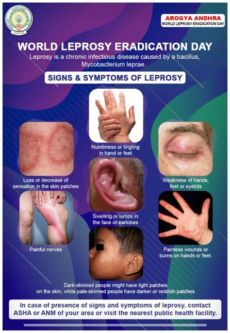 Leprosy Symptoms