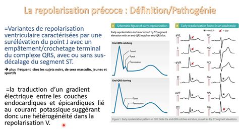 La Repolarisation Pr Coce Ce N Est Plus Anodin Youtube