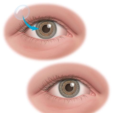 Episode 77 Corneal Transplants Selection Criteria — Eyes For Ears