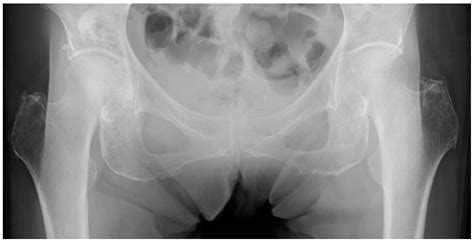 Proposed Modified Garden Classification Of Undisplaced And Descubra A