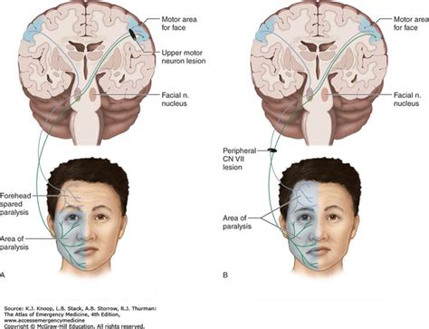 Related Image Motor Neuron Forehead Face