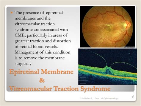 Cystoid macular oedema