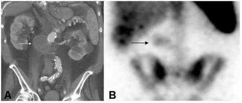 4. Abdominal abscess (courtesy of C. Palestro, Long Island Hospital ...