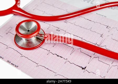 Rapport D Cocardiographie Ecg Montrant Un Battement De Coeur