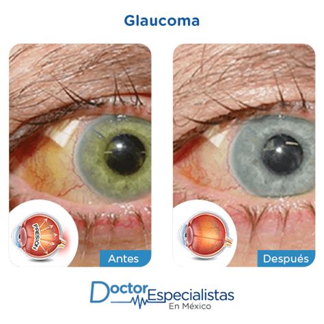 Mejores Oftalmologos Para Cirugia De Glaucoma Doctor Especialistas