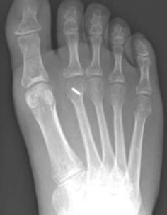 5th Metatarsal Osteotomy