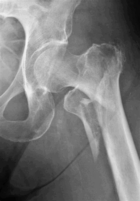 Epidemiology Of Osteoporotic Fracture An Overview Ros