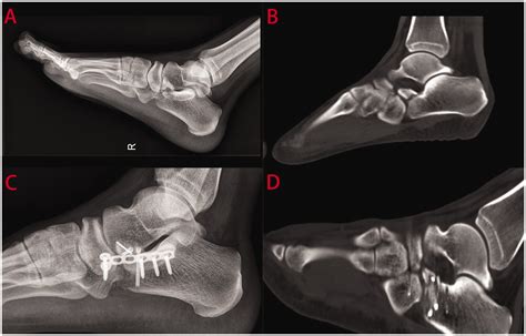 Anterior Calcaneus Fracture