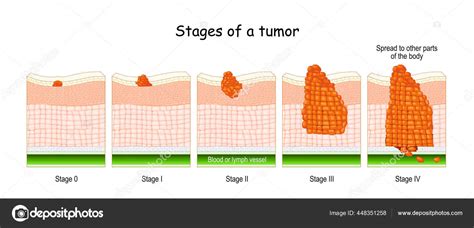 Stades Cancer Classification Des Tumeurs Malignes Système Qui Est