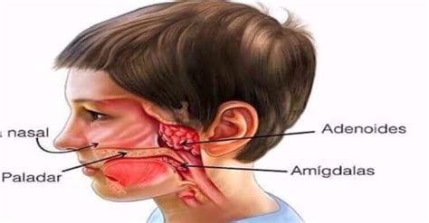 Como é Cirurgia de Adenoide particular e pelo Sus Como Conseguir
