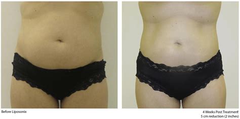 Липосоникс Отзывы Реальные Фото — Картинки фотографии