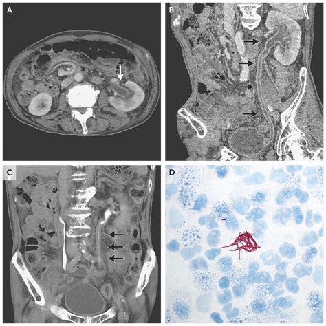 Urinary Tract Tuberculosis Medizzy