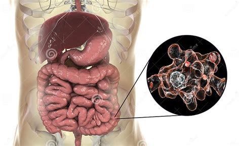 Entamoeba Histolytica Protozoan Infection Of Large Intestine Stock Illustration Illustration