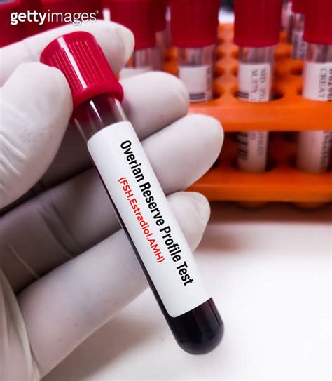 Doctor Holding A Blood Sample For Ovarian Reserve Test Ort Is A Test