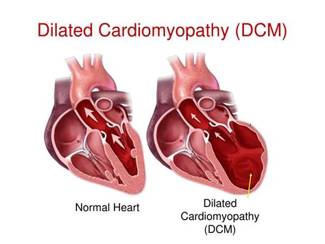 Ppt Cardiomyopathies Andre Keren Md Powerpoint Presentation Free