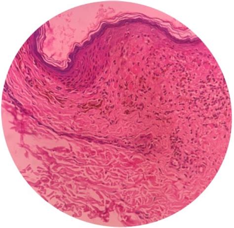 Histopathological appearance of Lichen Planus. | Download Scientific ...