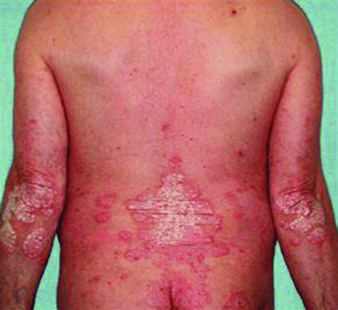 Localized Pustular Psoriasis Download Scientific Diagram