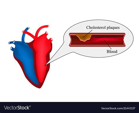 Atherosclerosis Of The Heart Angina Pectoris Vector Image