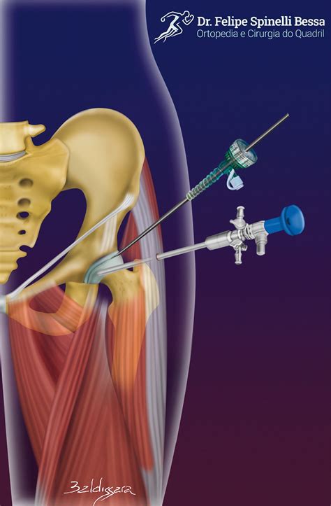 Lesão Labral Dr Felipe Bessa Especialista em Quadril