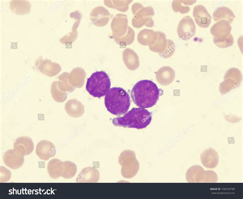 Acute Myelogenous Leukemia Aml M7 Micromegakaryocytic Stock Photo