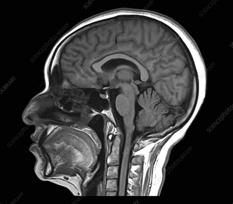 Pineal Gland Sagittal Mri