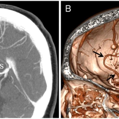 Schematic Drawings Of Azygos Anterior Cerebral Artery Types A Type A