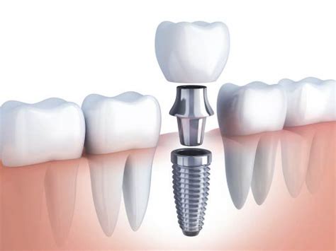 Implantes Dentales En Cdmx Cl Nica Dental Dr Molina