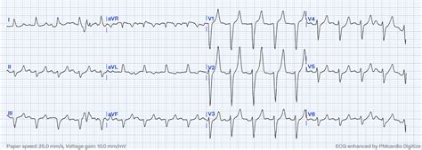 Hyperacute T-Waves: A Comprehensive Pattern Exploration