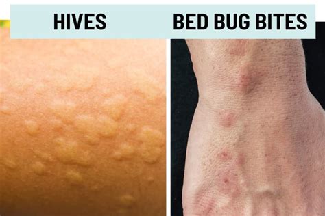 Hives Vs Bed Bug Bites Pictures And Differences Nbkomputer