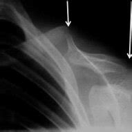 Radiographically Clavicular Hypoplasia And Abnormal Morphology Are