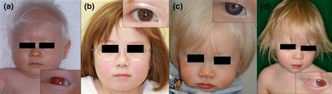 Current Landscape Of Oculocutaneous Albinism In Japan, 46% OFF