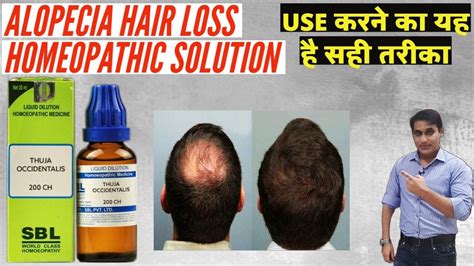 How To Use Homeopathic Medicine Thuja Occidentallis For Alopecia Areata Stop Hair Loss Regrow