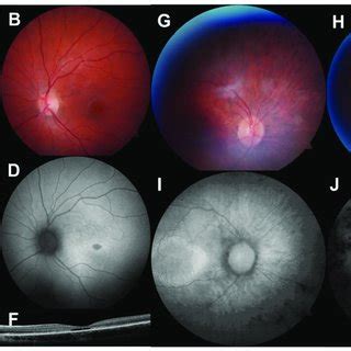 Multimodal Retinal Imaging Of 2 Paediatric IRD Cases A B Colour