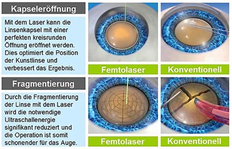 Femtolaser Katarakt Operation Augencentrum Dresden De