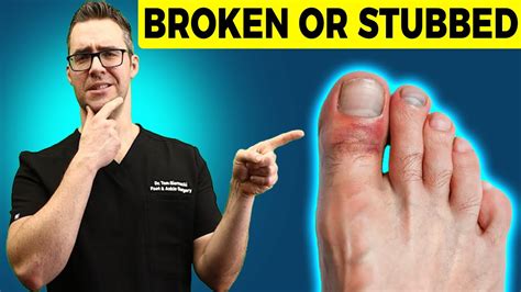 Stubbed Toe Or Broken Toe [symptoms Pain Relief And Treatment ] Youtube