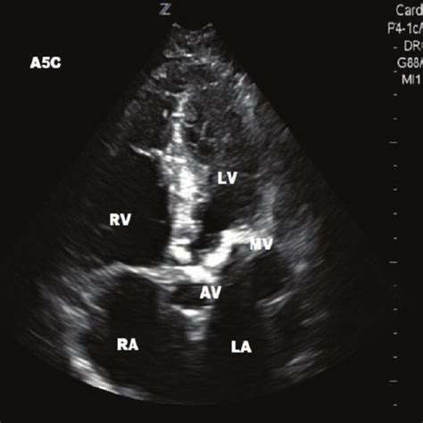 Parasternal long-axis view of the heart. The right heart is in the near ...
