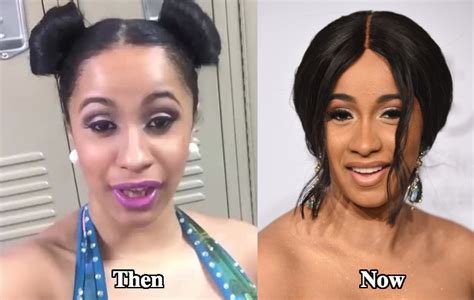 Cardi B Teeth - Did She Fix Them? - Latest Plastic Surgery Gossip And ...