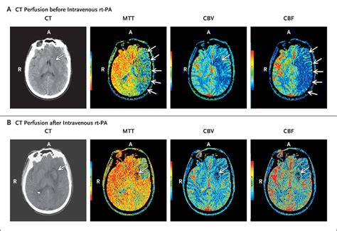 Intravenous Thrombolytic Therapy For Acute Ischemic Stroke New England Journal Of Medicine