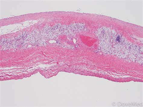 Pericarditis