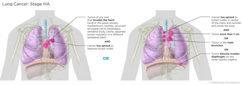 Lung Cancer Staging Lungevity Foundation