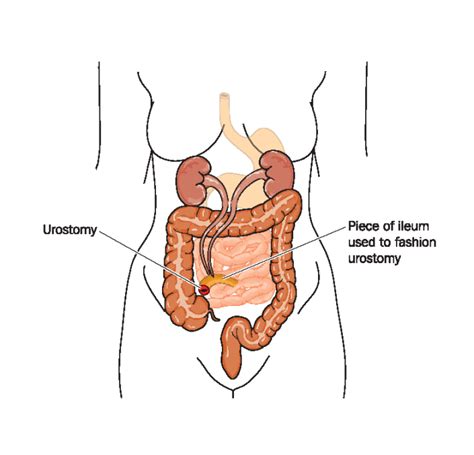 Urostomy | Ostomy, Ostomy supplies, Bladder